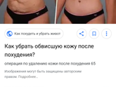Обвисш.кожа на животе и на ляхах после родов.