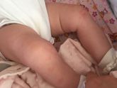 Сыпь. Аллергия ?!