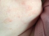 Потница или аллергия?