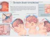 Синдром shaken baby! Читать всем! Важно!