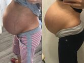 Через сколько времени после опущения живота вы рожали девочки?