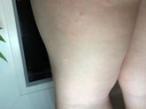 Аллергия или что?