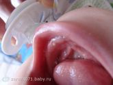Прыщик на десне или это зуб?