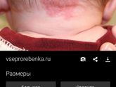 Родовое пятно