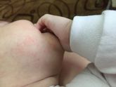 Девочки подскажите эта аллергия