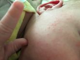 Как поспит на щечке сразу высыпает