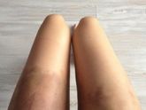 Антицеллюлитный массаж