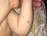 Пятнышки появились ,не ветрянка