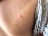 Что за прыщики .. может у кого было подобное?
