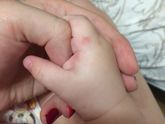 Боте эти прыщи не