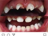 Гипоплазия зубной эмали у деток?! У кого было?