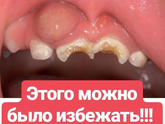 Что эта за шишка. Просто видела у взрослого