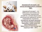 Писсарий на 30/31 недели?