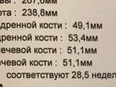 Разная длина бедренной кости