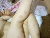 Лямблии в год, как лечить?