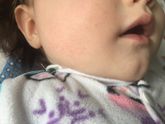 Сыпь на щеках и подбородке