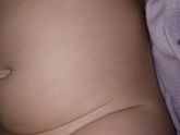 Девочки сыпь подскажите что это