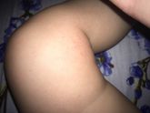 Аллергия?