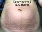 Борьба с растяжками. 2 шлифовка