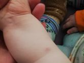 Какой должна быть реакция на Манту?
