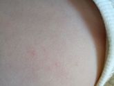 Аллергия или потница?