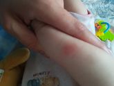 укусы или аллергия?