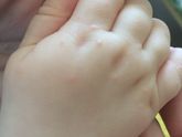 Сыпь