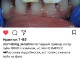 зубы,гипоплазия