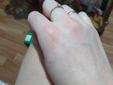 Высыпание