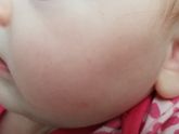 Аллергия?