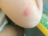 Укусы???