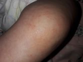 Аллергия на коровий белок., какие симптомы??