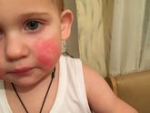 Мазь календулы и атопический дерматит