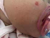 Красные маленькие пятнышки на щеке( 4 штучки)