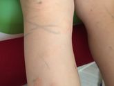Аллергия?