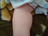 Аллергия