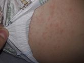 Сыпь