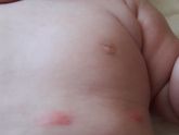 прыщи (укус или аллергия ?