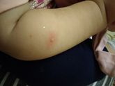 Подозрение на ветрянку, к