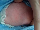 Пищевая аллергия?