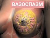 Вазоспазм