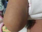 Потничка или продолжение аллерги ? Я скоро сойду с ума 😭😭😭