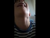 Гипертрофия миндалин и их лечение/удаление