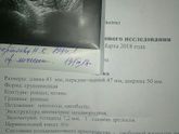 Киста после Визанны