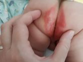 Посоветуйте пожалуйста чем мазать,