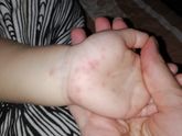 Сыпь