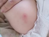 Место от укола АКДС, посмотрите, пожалуйста.