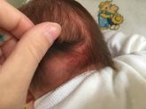 Краснота на затылке и прыщики(натерла?(