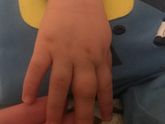 У ребёнка распух палец