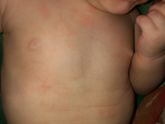 SOS Аллергия?
